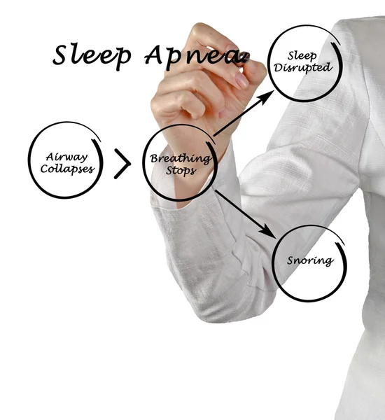 Апноэ сна — стоковое фото