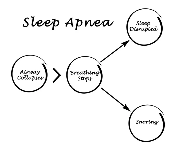 Apnea del sueño — Foto de Stock