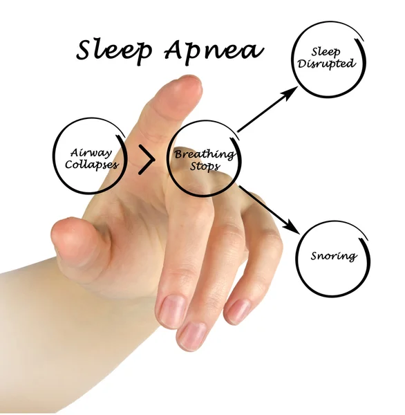 Apneia do sono — Fotografia de Stock