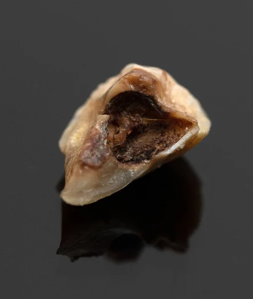 Ludzkie Próchnice Zębów Czarnym Tle — Zdjęcie stockowe