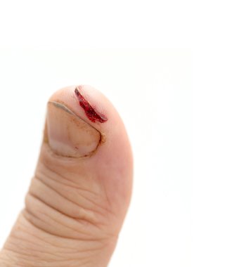 kirli açık kesim ile yaralı parmak