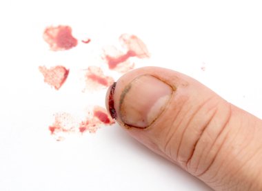 Injured finger with dirty open cut clipart