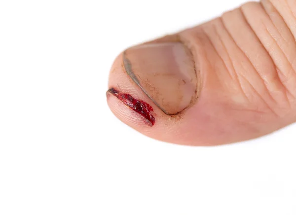 Verletzter Finger mit schmutzigem offenen Schnitt — Stockfoto