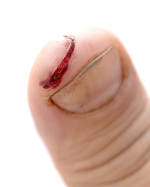 Dedo ferido com corte sujo aberto — Fotografia de Stock