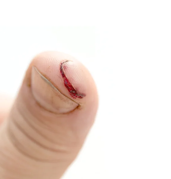 Verletzter Finger mit schmutzigem offenen Schnitt — Stockfoto