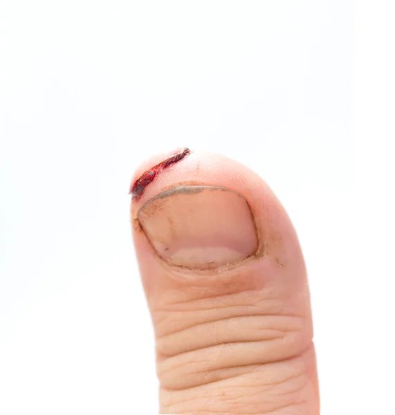 Verletzter Finger mit schmutzigem offenen Schnitt — Stockfoto