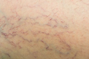 Derideki varis damarları.