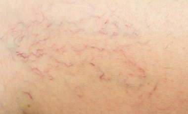 Derideki varis damarları.