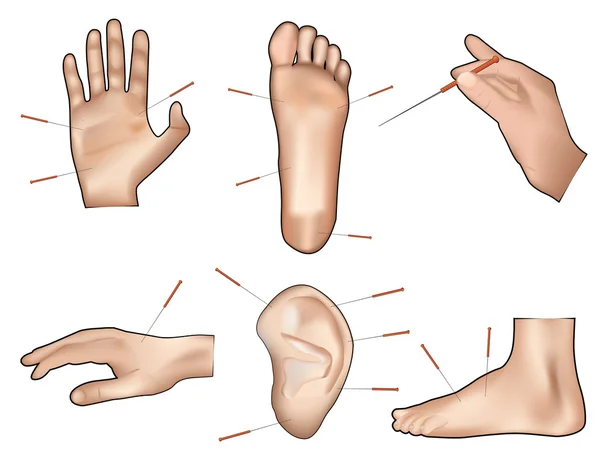 Illustrazione vettoriale dell'agopuntura — Vettoriale Stock