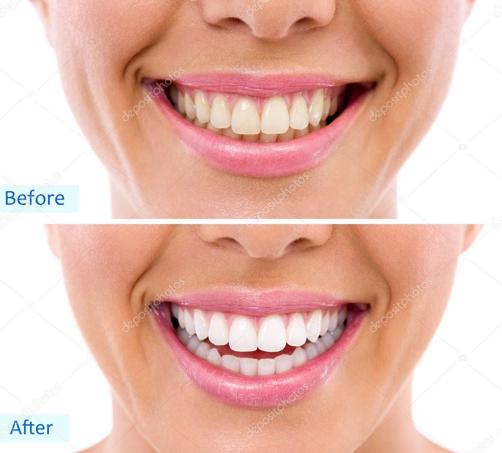 Whitening - bleaching treatment ,woman teeth and smile, before after