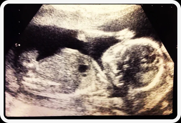 Ultrasound of baby — Stock Photo, Image