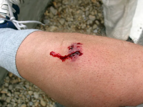 Dog Bite Wound — Stock Photo, Image