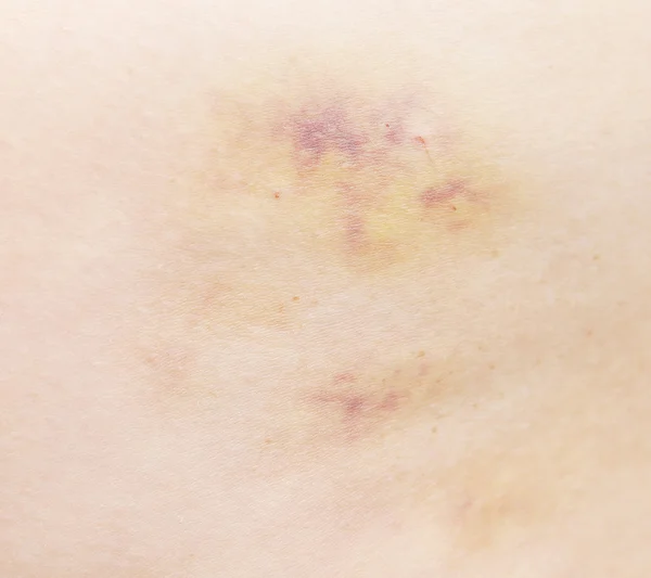 Hematomas — Fotografia de Stock