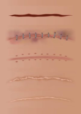 Set of healing wounds, skin scars, stitched gash and cuts. Realistic surgical sutures, stitched wounds at different healing stages isolated on human skin background clipart