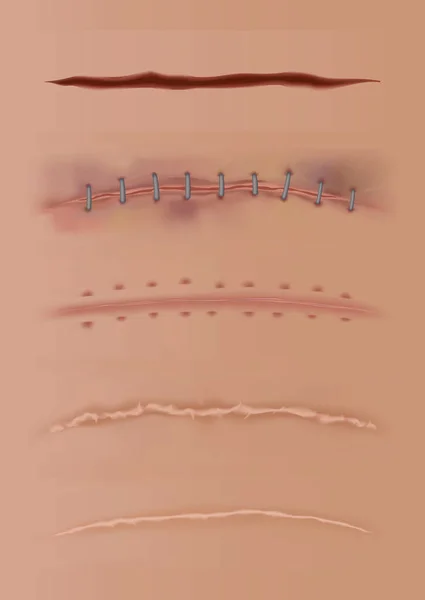 Conjunto de heridas curativas, cicatrices en la piel, herida cosida y cortes. Suturas quirúrgicas realistas, heridas cosidas en diferentes etapas de curación aisladas en el fondo de la piel humana — Vector de stock