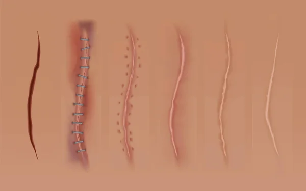 Uppsättning läkande sår, hudärr, sydda sår och skärsår. Realistiska kirurgiska suturer, sydda sår vid olika läkningsstadier isolerade på mänsklig hud bakgrund — Stock vektor