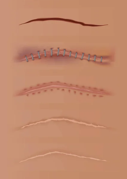 Conjunto de heridas curativas, cicatrices en la piel, herida cosida y cortes. Suturas quirúrgicas realistas, heridas cosidas en diferentes etapas de curación. Recogida de rupturas en el tejido corporal — Archivo Imágenes Vectoriales