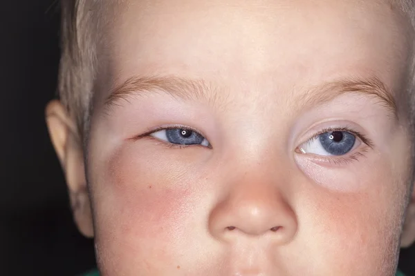 Hinchazón debajo de los ojos de un niño mordido por un mosquito — Foto de Stock
