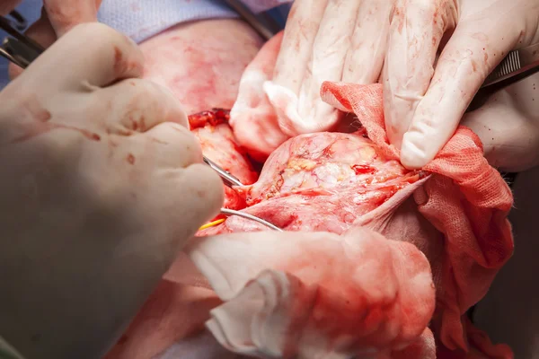 Close-up operation to remove the tumor — Stock Photo, Image