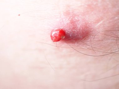 Sivilceden kan ve irin çıktı.