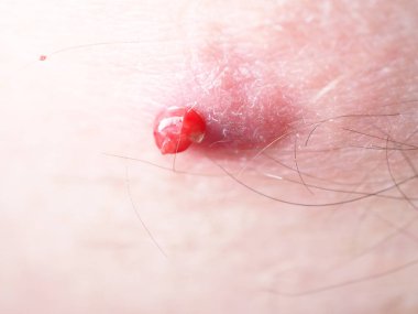 Sivilceden kan ve irin çıktı.