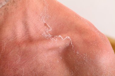 Güneş yanığından sonra derisi soyuluyor