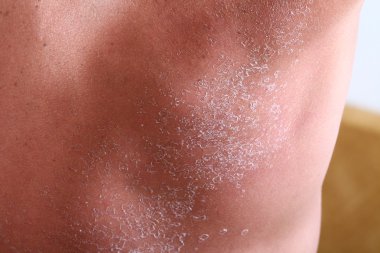 Güneş yanığından sonra derisi soyuluyor