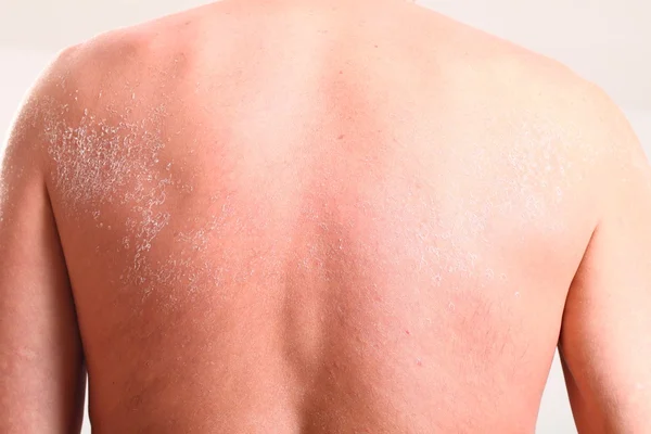 Skin peeling after sunburn — Stock Photo, Image
