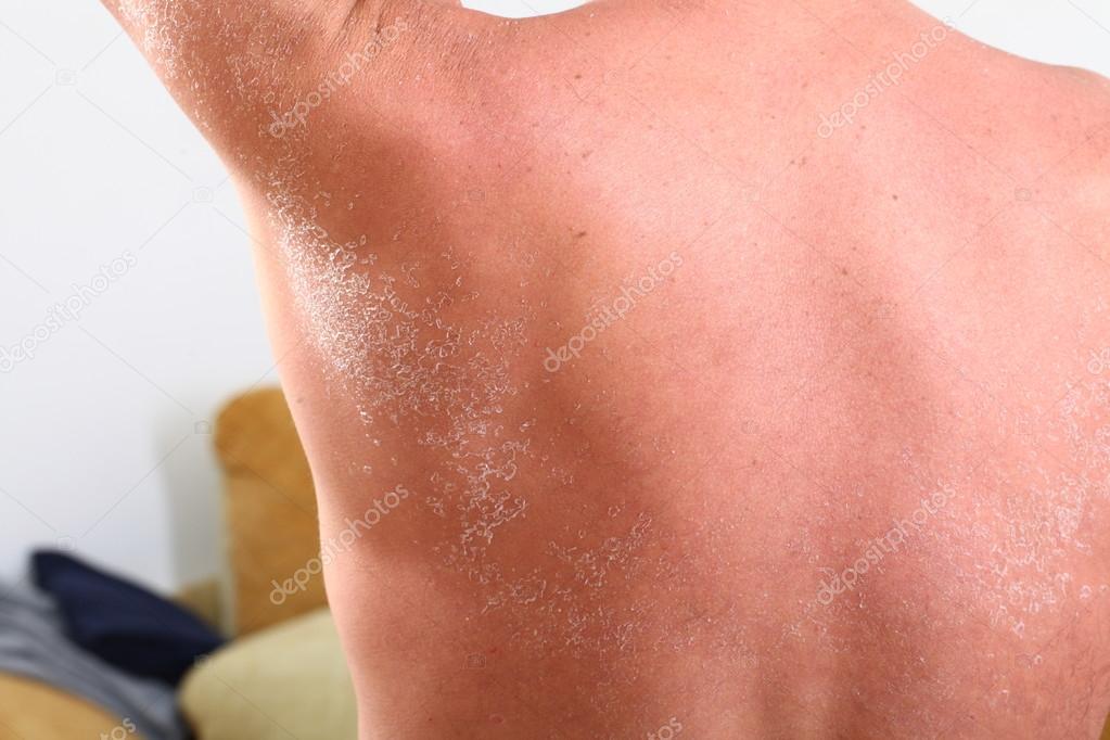 Skin peeling after sunburn