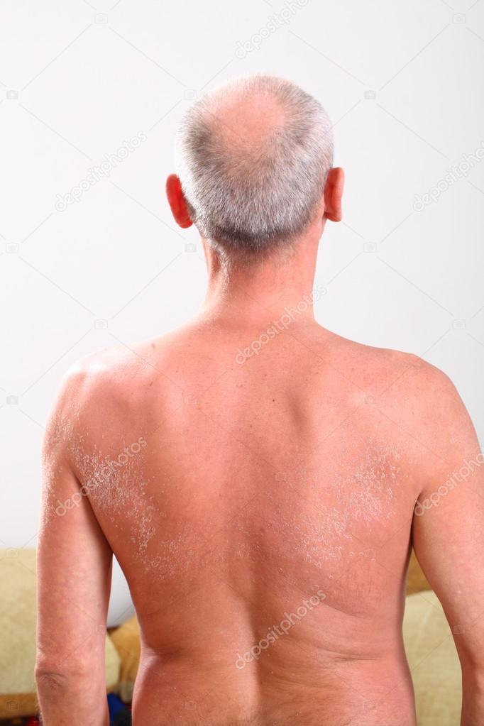 Skin peeling after sunburn
