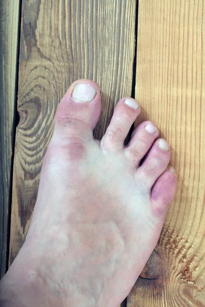 Foot disease, skin infections — Stock Photo, Image