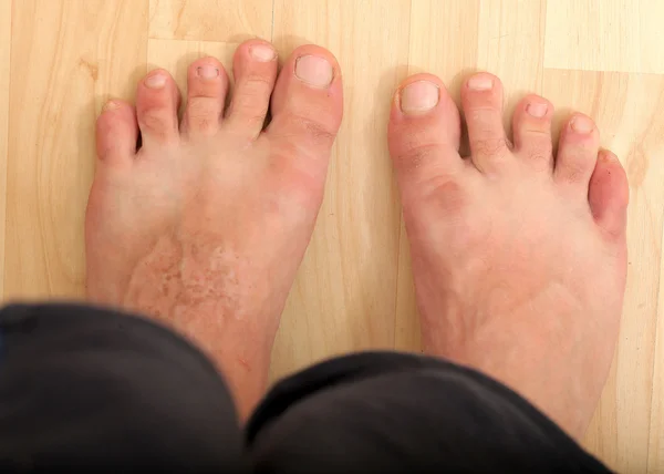 Enfermedad del pie, infecciones cutáneas —  Fotos de Stock