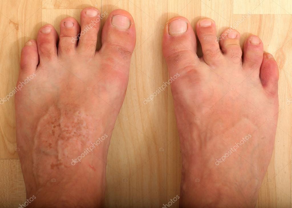 Foot disease, skin infections — Stock Photo © Omstudio 66476191