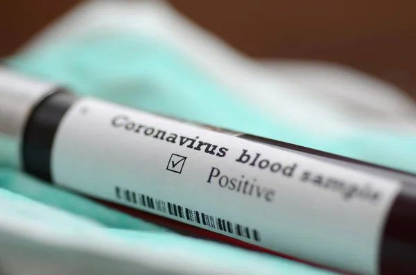 Coronavirus 2019 Ncov Kan Örneği Salgın Virüsü Solunum Sendromu Fotoğrafı — Stok fotoğraf