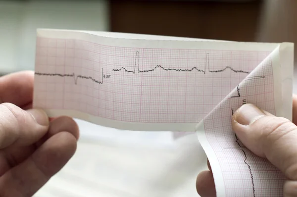 EKG pacjenta w ręce lekarza — Zdjęcie stockowe