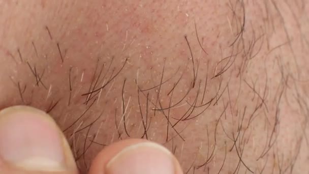 Man Runs His Fingers Bristling Cheek Touches Skin Need Shave — Stock Video