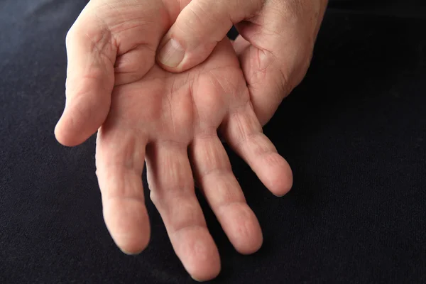 Homem com dor na palma da mão — Fotografia de Stock