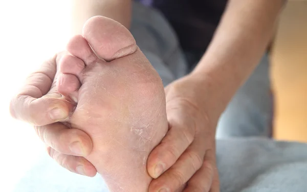 Homme avec pieds d'athlètes démangeaisons cutanées — Photo