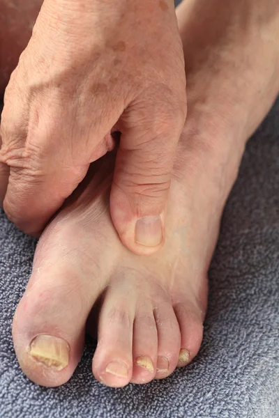 Champignon ongle du pied sur l'homme âgé — Photo