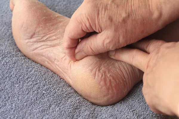 Ein Mann, der trockene Haut aus seinem Fuß schält — Stockfoto