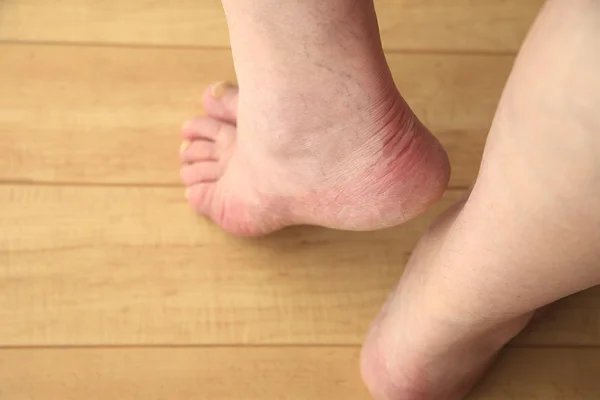 Senior man shows a heel — Stock Photo, Image