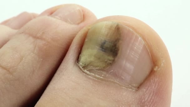 Fungo tra rimedio di gente di dita del piede