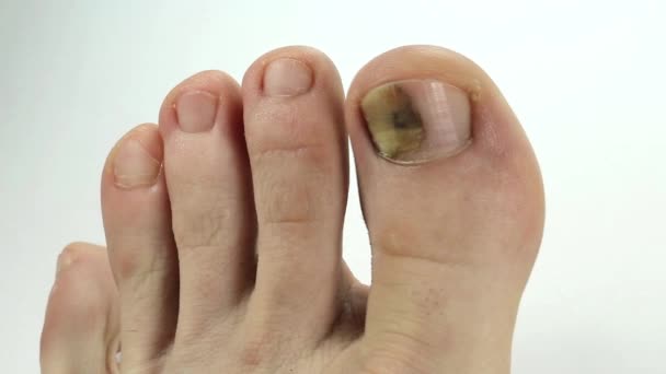 Perché le dita su mani su trattamento di unghie scoppiano