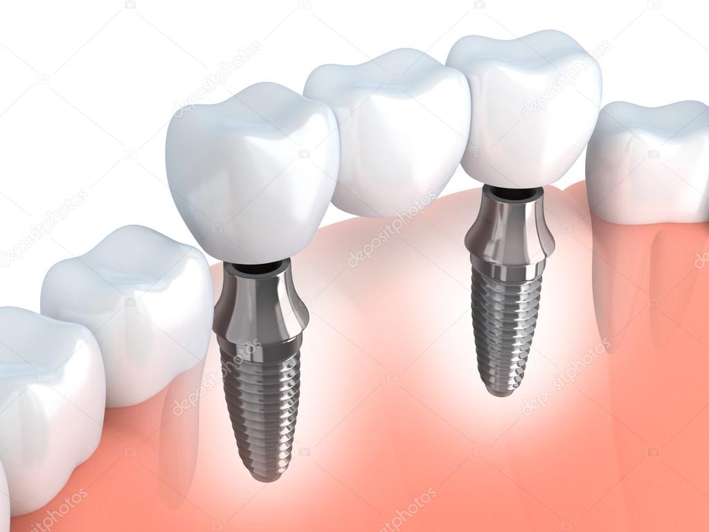 implante dentário — Fotografias de Stock © Vladru #67413129