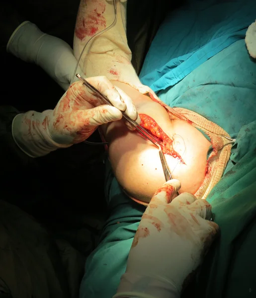 Chirurgii ortopedycznej ramię — Zdjęcie stockowe