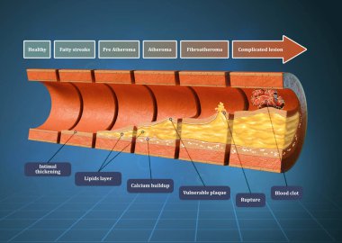 İnsan kan damarının aterosklerozu ile ilgili adımlar. Dijital illüstrasyon, 3B canlandırma.