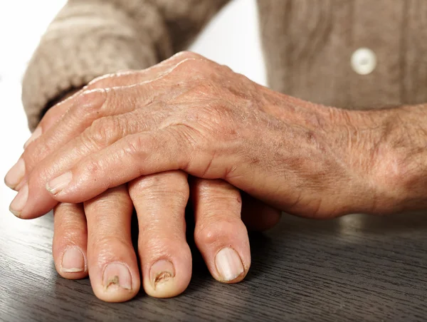 Mãos velhas com artrite — Fotografia de Stock