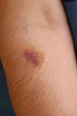 Görünür bir morluk ve yaralanma olan bir adamın koluna yakından bakın..