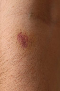 Görünür bir morluk ve yaralanma olan bir adamın koluna yakından bakın..