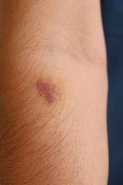 Görünür bir morluk ve yaralanma olan bir adamın koluna yakından bakın..